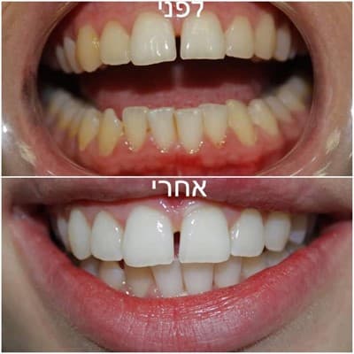 הלבנת שיניים (הלבנה) ליזר הבהרת שיניים 