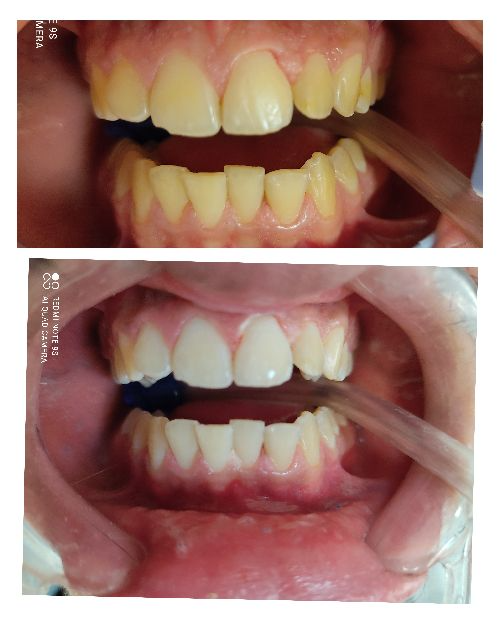 הלבנת שיניים מרפאתית