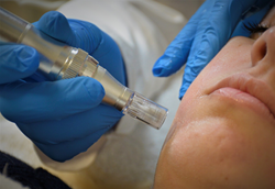 mesotherapy treatment