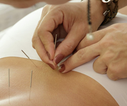 Chinese acupuncture treatment