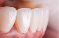 לבן ונוצץ: הכל על ציפוי חרסינה לשיניים