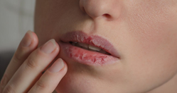 פיגמנטציה בשפתיים: דרכי טיפול ומניעה