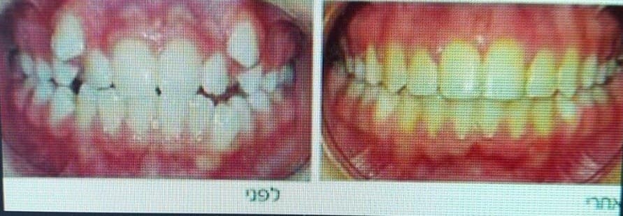 ד"ר הררי דורון-אורטודנטיה יישור שיניים image